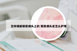 怎樣緩解銀屑病頭上的 銀屑病頭皮怎么護(hù)理