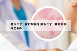 腋下長了一片紅癬很癢 腋下長了一片紅癬很癢怎么辦