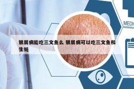 銀屑病能吃三文魚么 銀屑病可以吃三文魚和生蠔