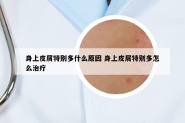 身上皮屑特別多什么原因 身上皮屑特別多怎么治療