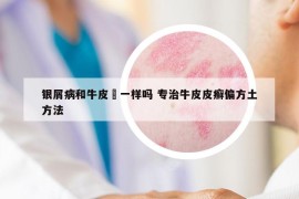 銀屑病和牛皮癬一樣嗎 專治牛皮皮癬偏方土方法