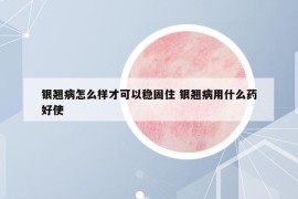 銀翹病怎么樣才可以穩(wěn)固住 銀翹病用什么藥好使