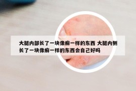 大腿內(nèi)部長(zhǎng)了一塊像癬一樣的東西 大腿內(nèi)側(cè)長(zhǎng)了一塊像癬一樣的東西會(huì)自己好嗎