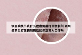銀屑病關(guān)節(jié)炎什么程度需要打生物制劑 銀屑關(guān)節(jié)炎打生物制劑后能像正常人工作嗎