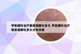 甲氨蝶呤治療銀屑病要吃多久 甲氨蝶呤治療銀屑病要吃多久才有效果