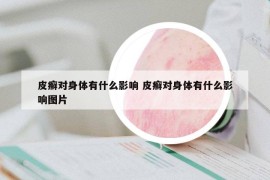 皮癬對身體有什么影響 皮癬對身體有什么影響圖片