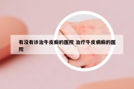 有沒有診治牛皮癬的醫(yī)院 治療牛皮病癬的醫(yī)院
