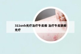311uvb光療治療牛皮癬 治療牛皮膚癬光療