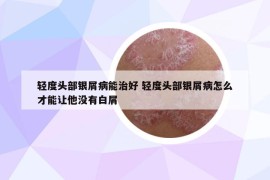 輕度頭部銀屑病能治好 輕度頭部銀屑病怎么才能讓他沒有白屑