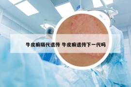 牛皮癬隔代遺傳 牛皮癬遺傳下一代嗎