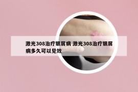 激光308治療銀屑病 激光308治療銀屑病多久可以見效