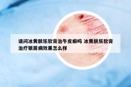 請問冰黃膚樂軟膏治牛皮癬嗎 冰黃膚樂軟膏治療銀屑病效果怎么樣