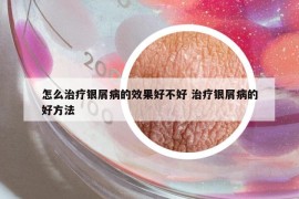 怎么治療銀屑病的效果好不好 治療銀屑病的好方法