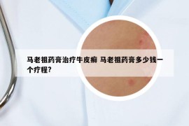 馬老祖藥膏治療牛皮癬 馬老祖藥膏多少錢一個(gè)療程?