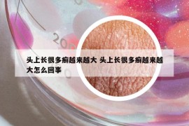 頭上長很多癬越來越大 頭上長很多癬越來越大怎么回事
