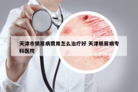天津市銀屑病費用怎么治療好 天津銀屑病?？漆t(yī)院