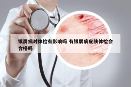 銀屑病對(duì)體檢有影響嗎 有銀屑病皮膚體檢會(huì)合格嗎