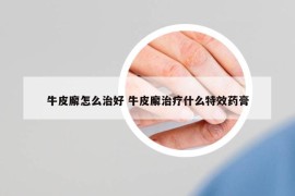 牛皮廨怎么治好 牛皮廨治療什么特效藥膏