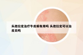 頭孢拉定治療牛皮癬有用嗎 頭孢拉定可以治皮炎嗎