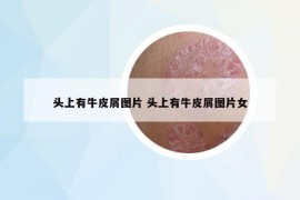 頭上有牛皮屑圖片 頭上有牛皮屑圖片女