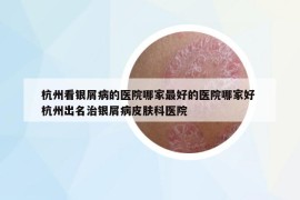 杭州看銀屑病的醫(yī)院哪家最好的醫(yī)院哪家好 杭州出名治銀屑病皮膚科醫(yī)院