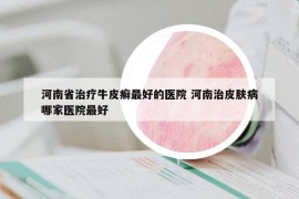 河南省治療牛皮癬最好的醫(yī)院 河南治皮膚病哪家醫(yī)院最好