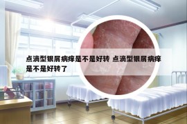 點(diǎn)滴型銀屑病癢是不是好轉(zhuǎn) 點(diǎn)滴型銀屑病癢是不是好轉(zhuǎn)了