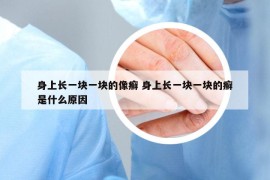 身上長一塊一塊的像癬 身上長一塊一塊的癬是什么原因