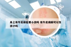 身上有牛皮癬能要小孩嗎 有牛皮病癬可以生孩子嗎