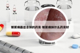 銀屑病最適合抹的藥膏 銀屑病抹什么藥膏好