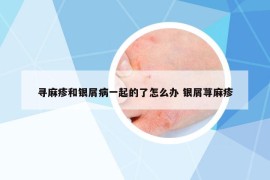 尋麻疹和銀屑病一起的了怎么辦 銀屑蕁麻疹