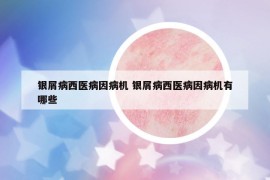 銀屑病西醫(yī)病因病機 銀屑病西醫(yī)病因病機有哪些