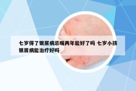 七歲得了銀屑病忌嘴兩年能好了嗎 七歲小孩銀屑病能治療好嗎