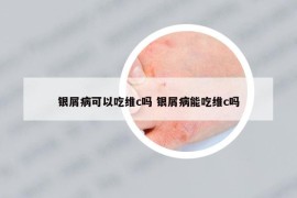 銀屑病可以吃維c嗎 銀屑病能吃維c嗎