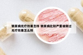 銀屑病光療效果怎樣 銀屑病比較嚴(yán)重誰做過光療效果怎么樣