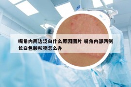 嘴角內(nèi)兩邊泛白什么原因圖片 嘴角內(nèi)部?jī)蓚?cè)長白色顆粒物怎么辦