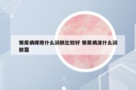 銀屑病癢擦什么潤膚比較好 銀屑病涂什么潤膚霜
