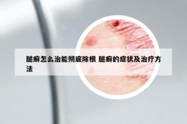 腿癬怎么治能徹底除根 腿癬的癥狀及治療方法