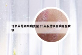什么茶是銀屑病克星 什么茶是銀屑病克星食物
