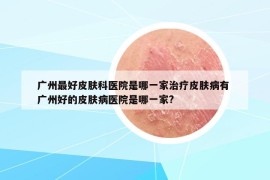 廣州最好皮膚科醫(yī)院是哪一家治療皮膚病有 廣州好的皮膚病醫(yī)院是哪一家?