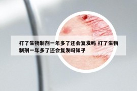 打了生物制劑一年多了還會(huì)復(fù)發(fā)嗎 打了生物制劑一年多了還會(huì)復(fù)發(fā)嗎知乎