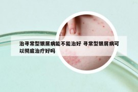 治尋常型銀屑病能不能治好 尋常型銀屑病可以徹底治療好嗎