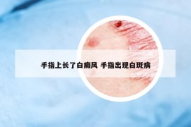 手指上長了白癜風 手指出現(xiàn)白斑病