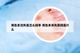 黑色素流失是怎么回事 黑色素丟失原因是什么
