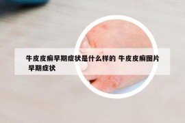 牛皮皮癬早期癥狀是什么樣的 牛皮皮癬圖片 早期癥狀