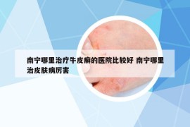 南寧哪里治療牛皮癬的醫(yī)院比較好 南寧哪里治皮膚病厲害