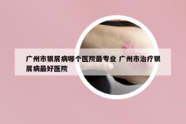 廣州市銀屑病哪個(gè)醫(yī)院最專業(yè) 廣州市治療銀屑病最好醫(yī)院