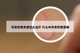 尋常性銀宵病怎么治療 什么叫尋常性銀霄病