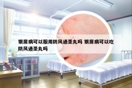銀屑病可以服用防風(fēng)通圣丸嗎 銀屑病可以吃防風(fēng)通圣丸嗎