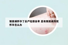 銀屑病懷孕了去產(chǎn)檢很自卑 患有銀屑病發(fā)現(xiàn)懷孕怎么辦